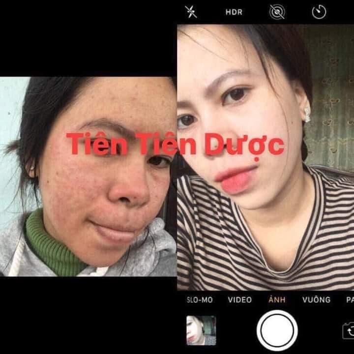 COMBO TÁI TẠO DA TIÊN TIÊN DƯỢC