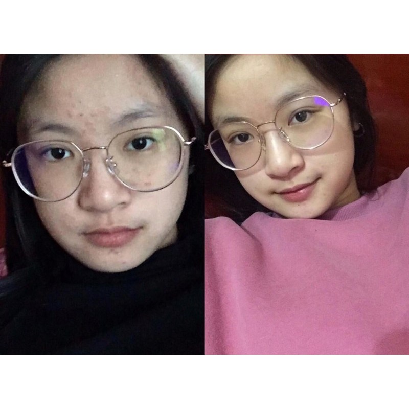 TURMERIC EXTRACT -ĐÁNH BAY MỤN ẨN VÀ CÁC LOẠI MỤN | BigBuy360 - bigbuy360.vn