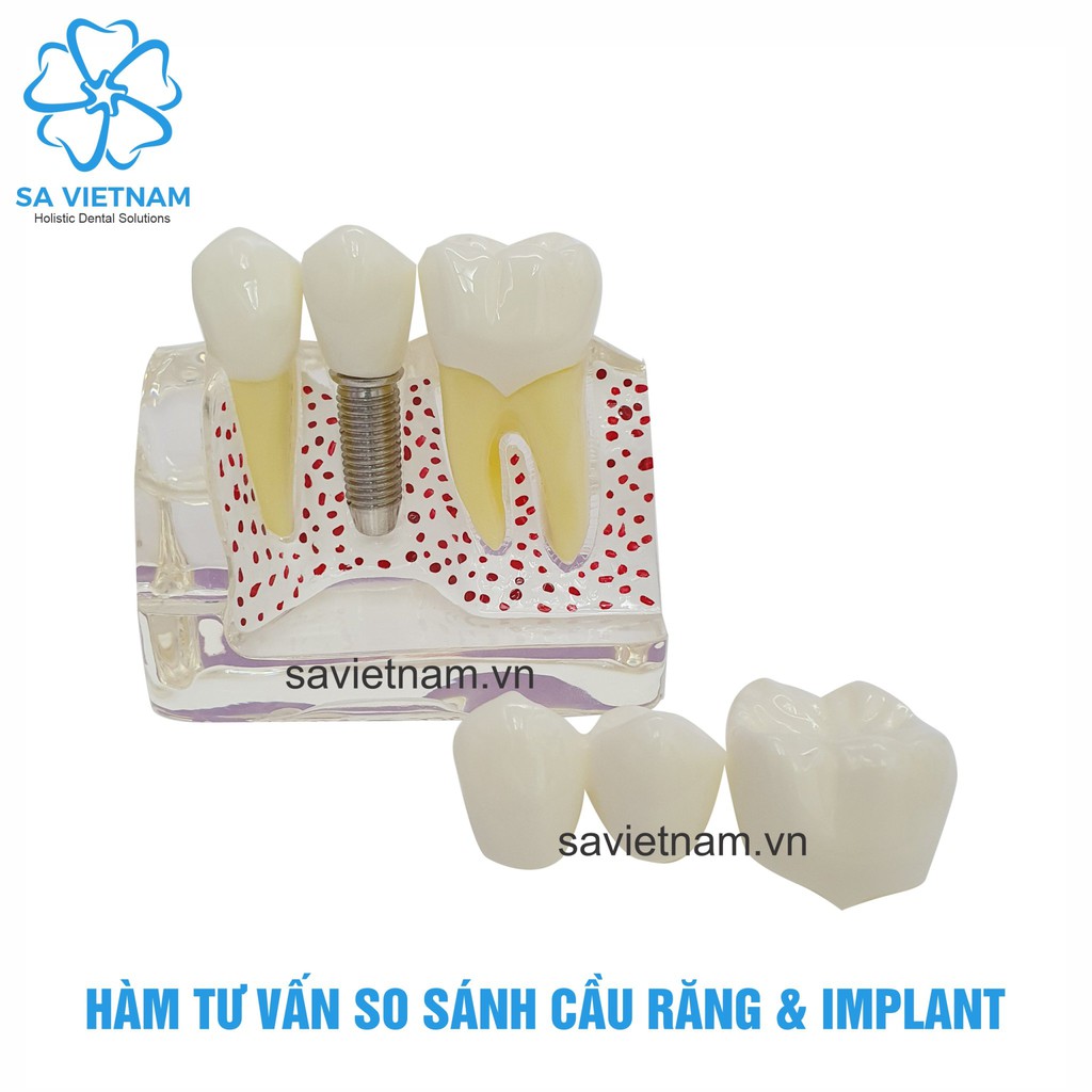 Mô hình hàm tư vấn so sánh cầu răng và implant - Mô hình răng thực hành nha khoa