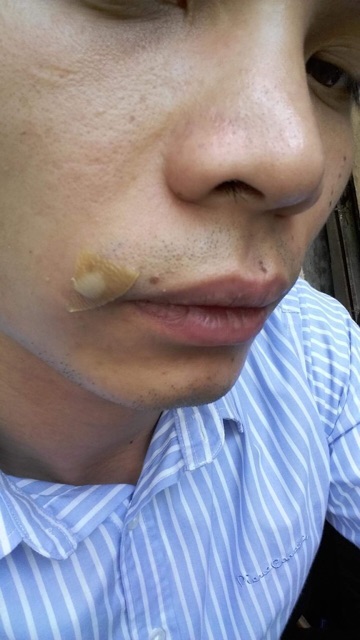 👉 Miếng dán mụn Duoderm Extrathin USA nk chính hãng | BigBuy360 - bigbuy360.vn