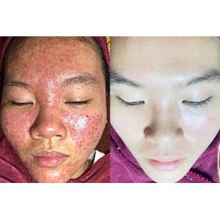 COMBO  MỤN DOCTOR NATURE