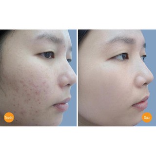 Cao Khổ Qua giảm mụn Cocoon 30ml