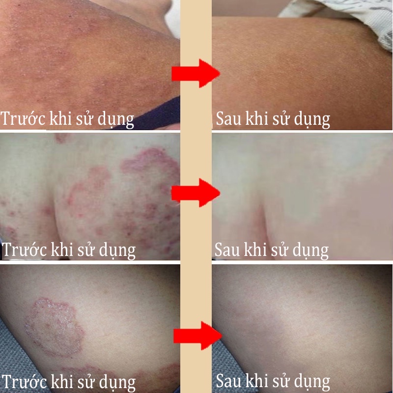Chăm sóc vùng kín Kem bôi ngoài da kem chống ngứa vùng kín Dung dịch vệ sinh nữ kem bôi hết sạch nấm ngứa