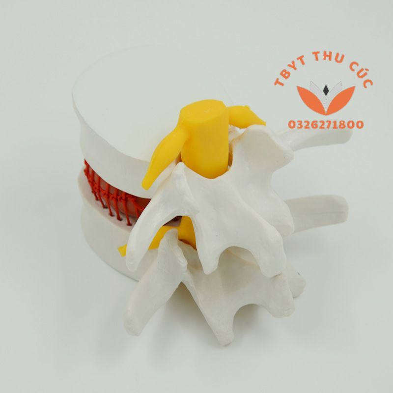 Mô hình thoát vị cột sống