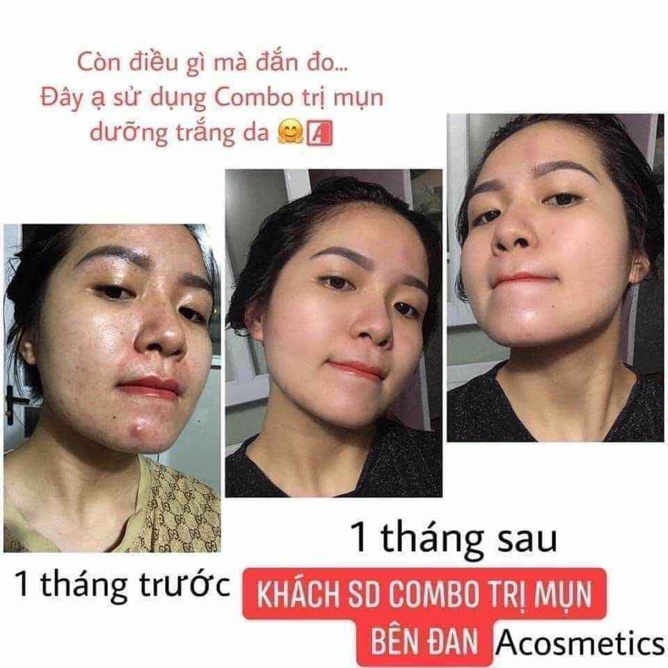 (Chính Hãng 100%) Kem Ngừa Mụn Siêu Tốc Độ Acosmetics, Gồm serum chấm mụn và Kem dưỡng ngừa thâm