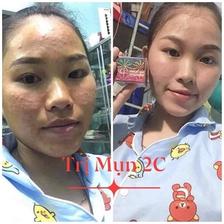KEM MỤN  2C 10G