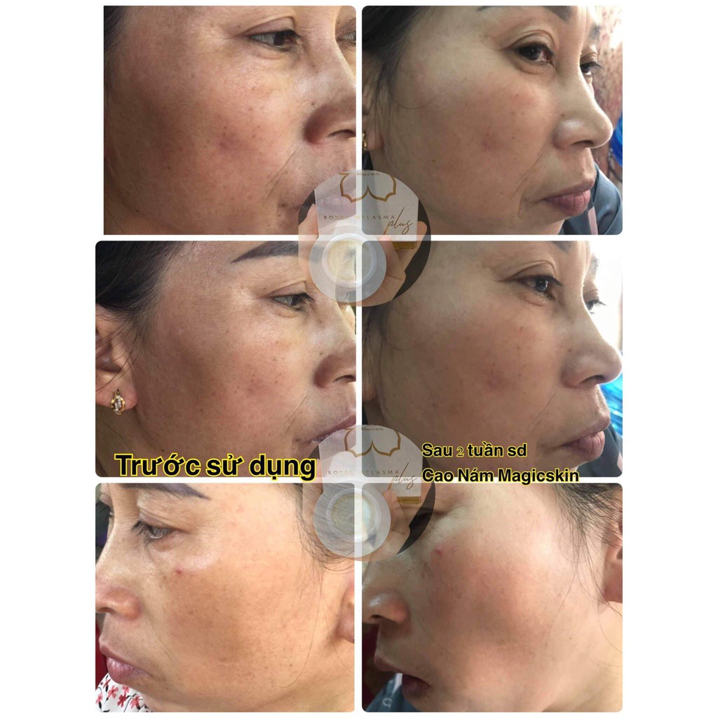 [Chính Hãng] Cao Nám Kem Ngừa Nám Tàn Nhang MagicSkin Royal Melasma Plus (size lớn) | BigBuy360 - bigbuy360.vn