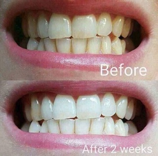 Bột tẩy trắng răng