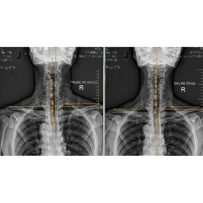 Gối cổ DoctorLoan F4- Gối điều trị thoát vị đĩa đệm, vẹo, trượt đốt sống cổ. Doctor Loan