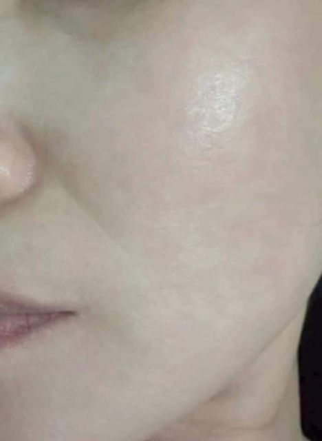 BỘ KEM NÁM TÀN NHANG CLOBETAMIL G CAO CẤP