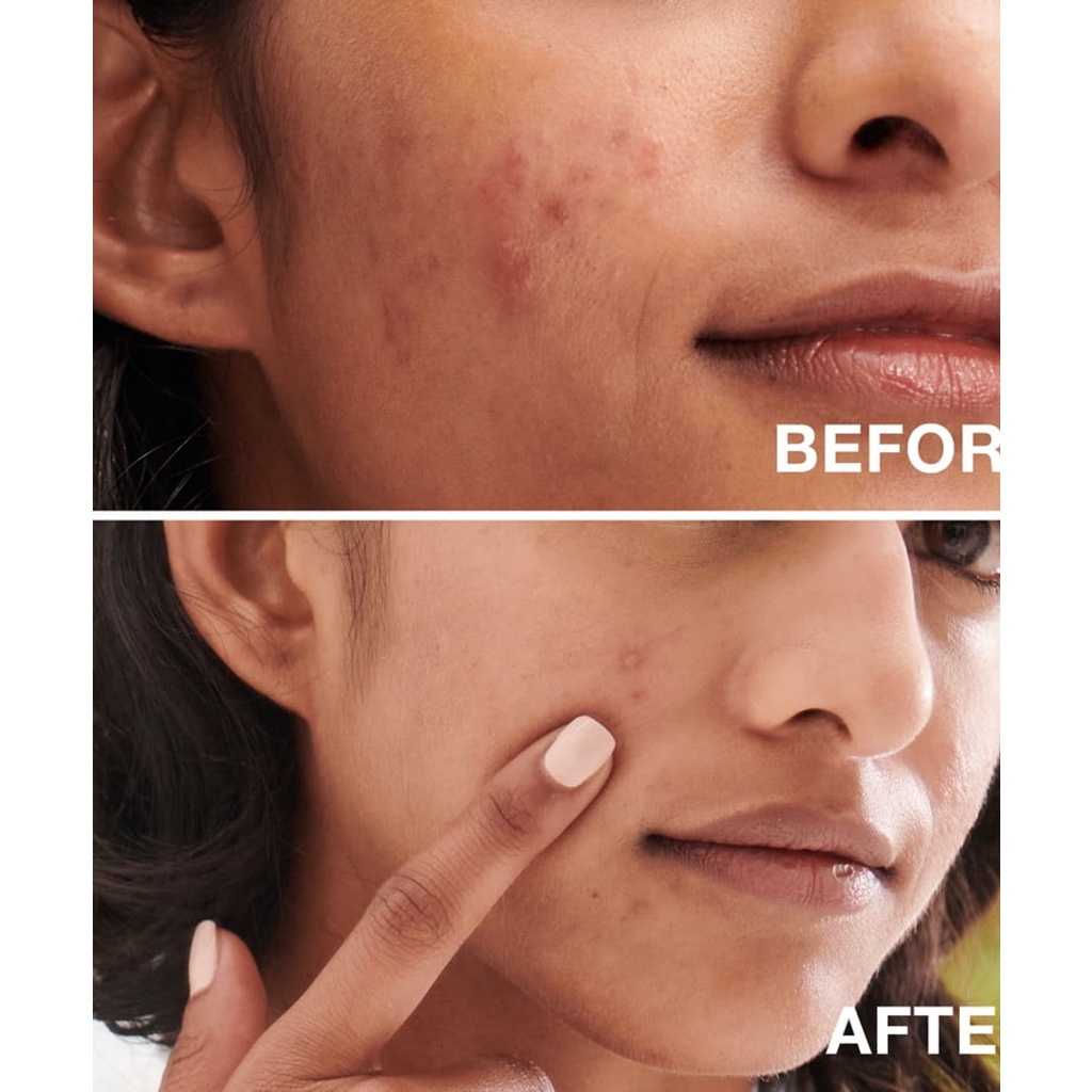 Sữa Rửa Mặt Neutrogena Oil-Free Acne Wash 269ml