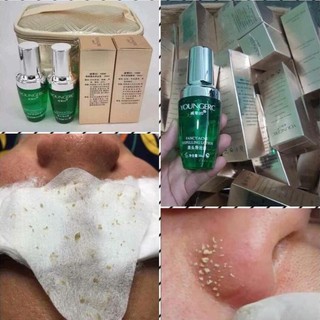 Ủ mụn Youngerc đầu đen, mụn cám Youngerc chai 30ml
