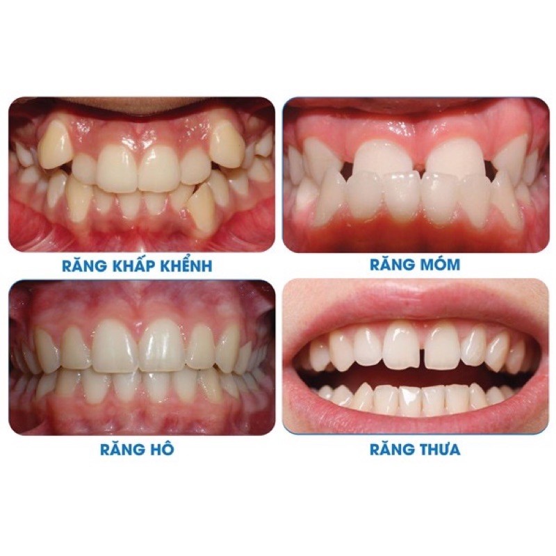 (Hỏa Tốc) Niềng Răng Tại Nhà | Bộ người lớn A1 + A2 + A3 ( 3 cái )