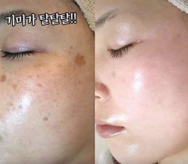 Kem Trắng Da Melasma-x 3D WHITENING CLINIC CREAM