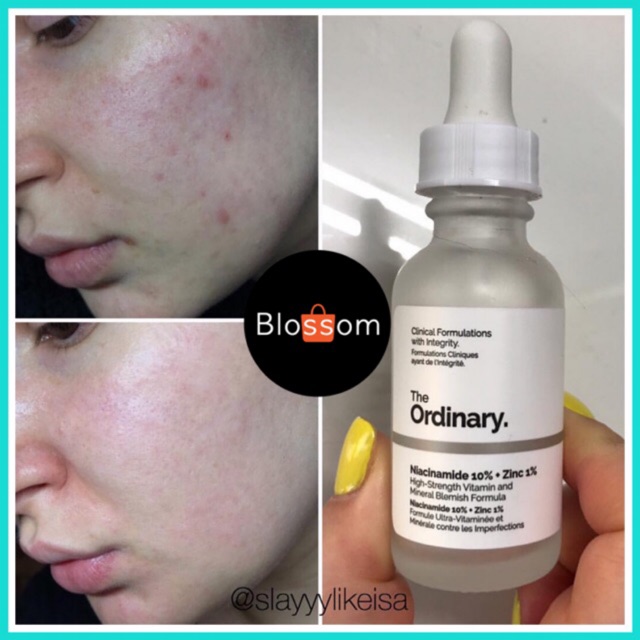 [30/60mL] Serum Tinh chất The Ordinary NIACINAMIDE 10% + Zinc 1%