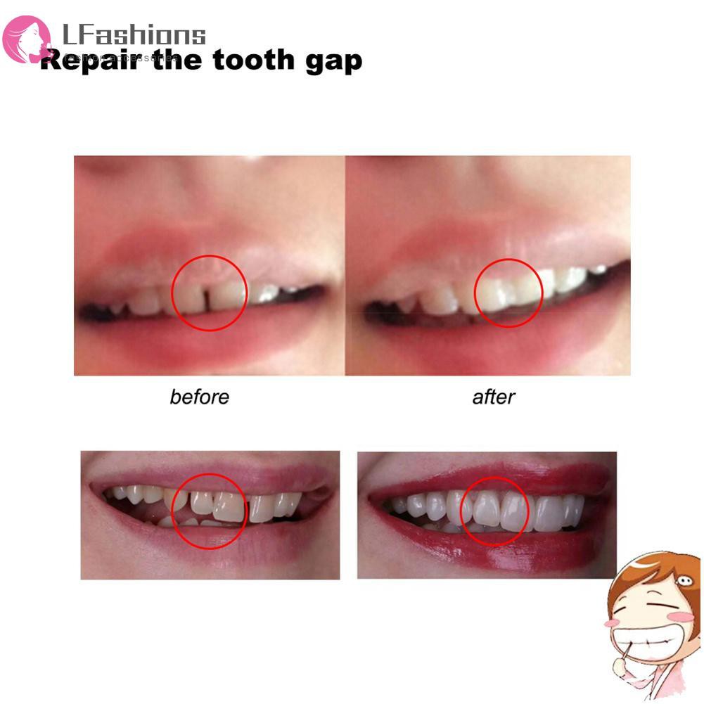 Keo trám khe răng 10/100g