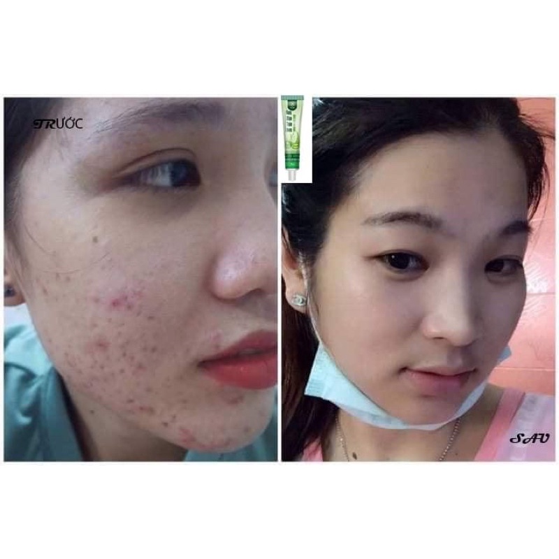 Kem trị_mụn sinori