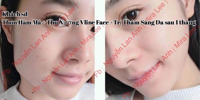 Tinh Chất Thu Xương Vline Face Hàn Quốc