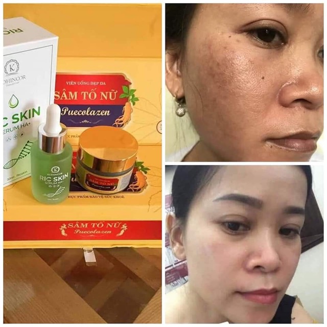 SÂM TỐ NỮ + serum + sữa rửa mặ RÍCKIN♥️♥️♥️👍