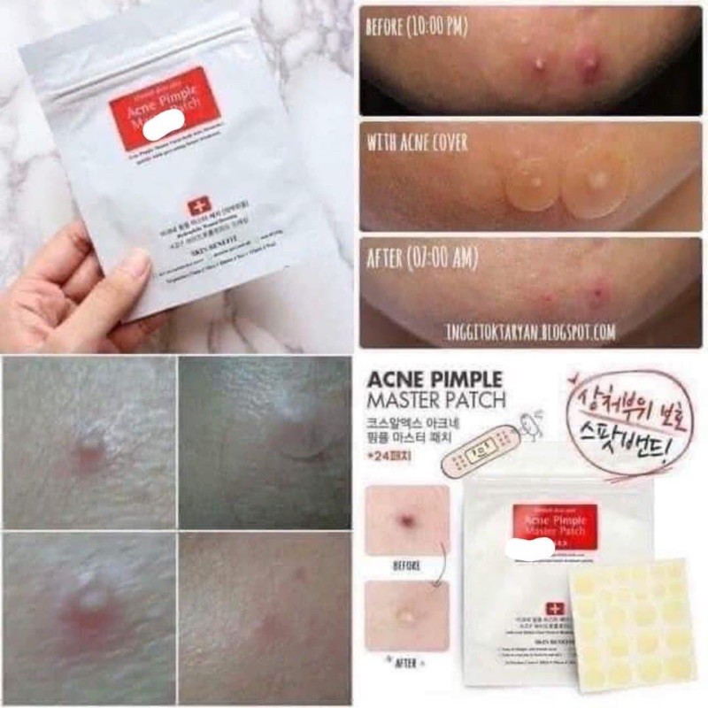 Dán mụn Cosrx Đỏ