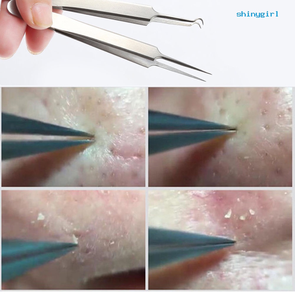 Nhíp Lấy Nhân Mụn Đầu Đen Tiện Lợi