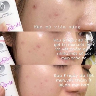 Bôi Mụn Megaduo gel 15g .
