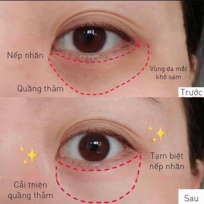 KEM DƯỠNG MẮT MỜ THÂM HIỆU QUẢ