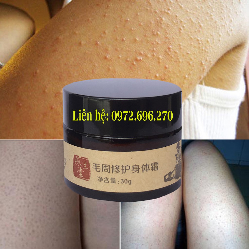 Kem bôi viêm nang lông - viêm lỗ chân lông [ Cực hiệu quả ] | BigBuy360 - bigbuy360.vn