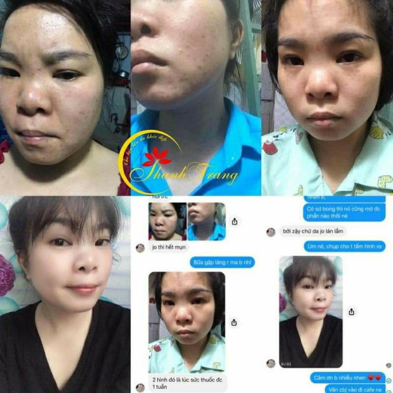 TÁI TẠO DA TRỪ MỤN NÁM THANH TRANG (LOẠI THƯỜNG VÀ CẤP TỐC) | BigBuy360 - bigbuy360.vn