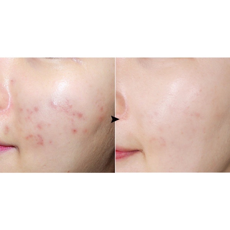 Gel bảo vệ da mụn rau má Prreti loại bỏ bã nhờn chăm sóc da dịu nhẹ tự nhiên 10g