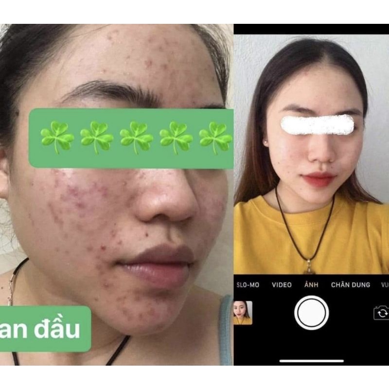 Kem giảm mụn, mờ thâm, làm trắng da Acne Derm 20% Azelaic