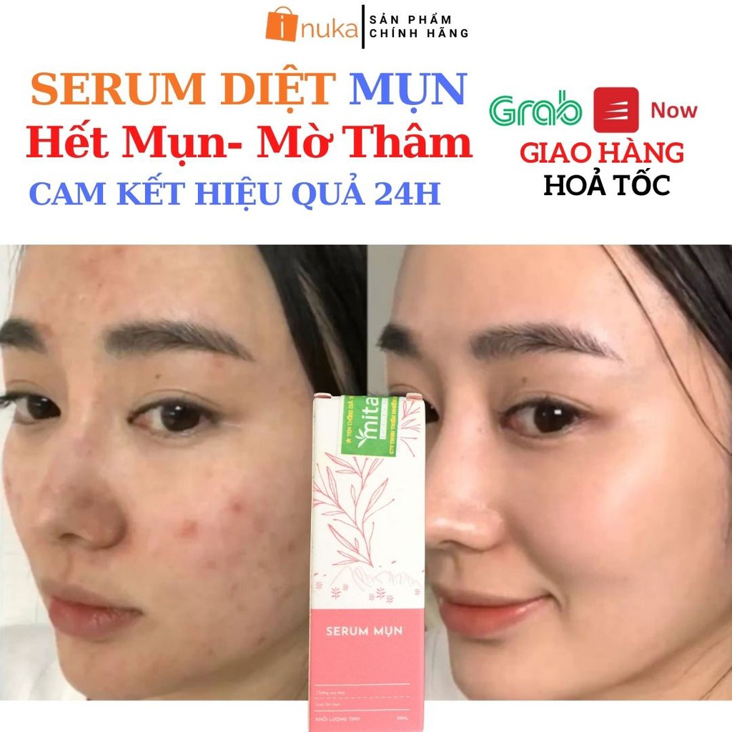[Hiệu Quả Nhanh] Serum mụn giảm mụn giảm thâm ngừa mụn phục hồi sáng da MITA (5ml-10ml).