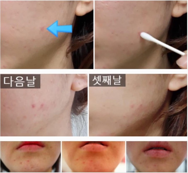 TINH DẦU CHẤM MỤN SOMEBYMI TEA TREE CLEAR SPOT OIL