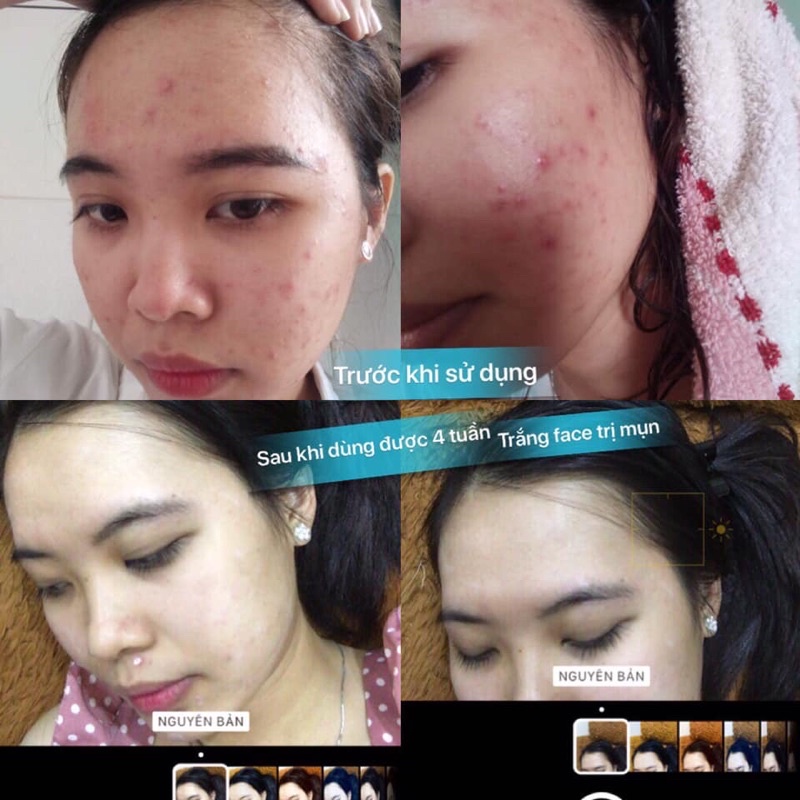 Kem mụn Victoria