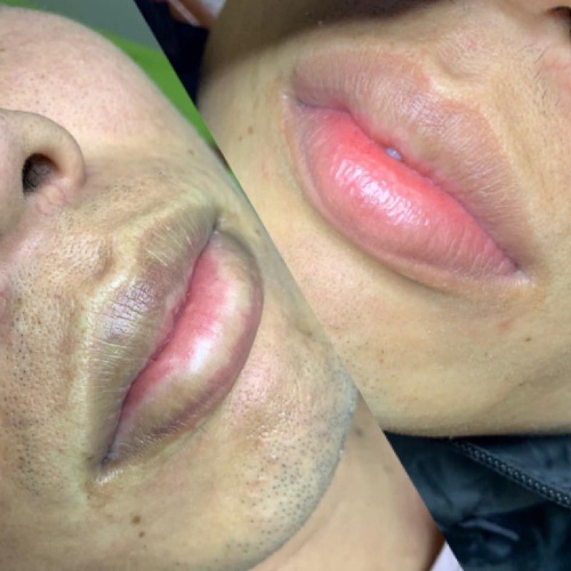 HCM [Voucher]- Khữ thâm Môi chỉ 30phut- Hoàng Wy Sp