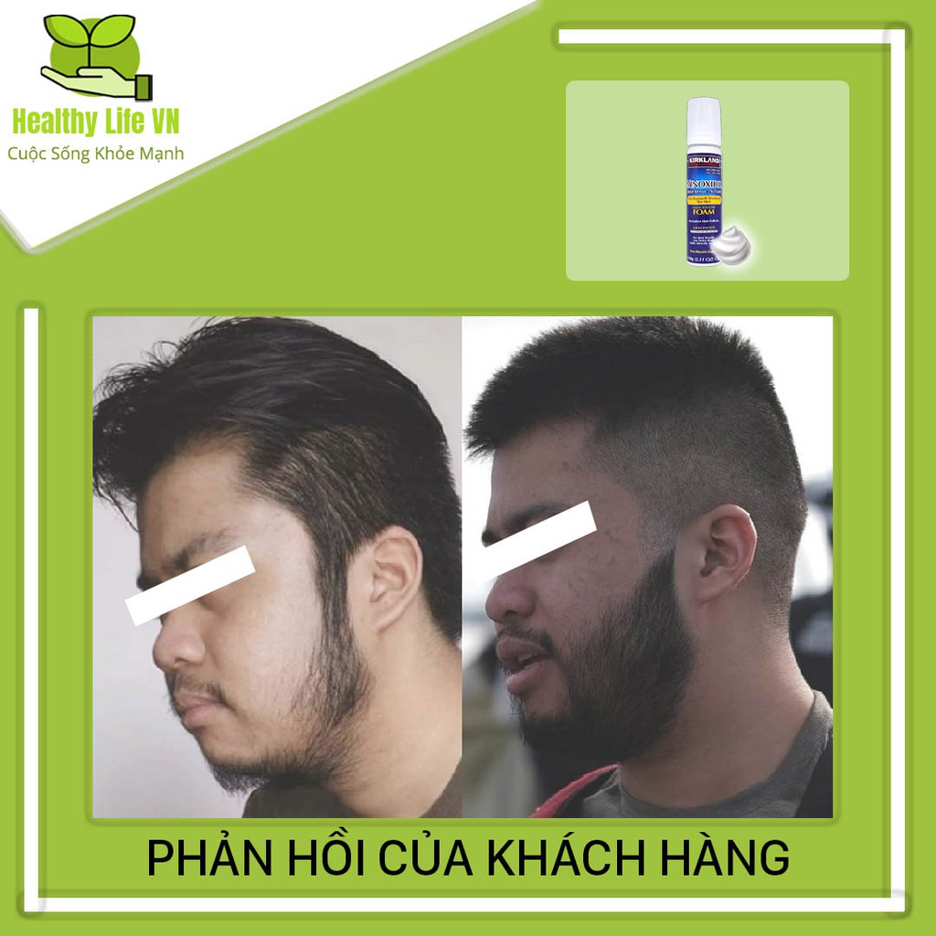 Minoxidil 5% Dạng Bọt Mọc Râu Tóc Kirkland Mỹ