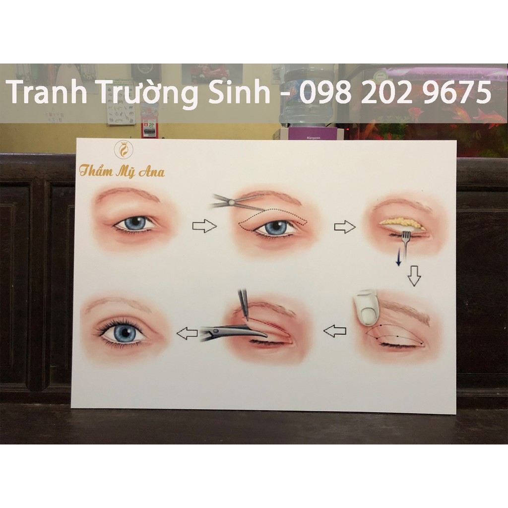 TRANH PHẪU THUẬT CẮT MÍ (Miễn phí thiết kế và chèn tên logo)