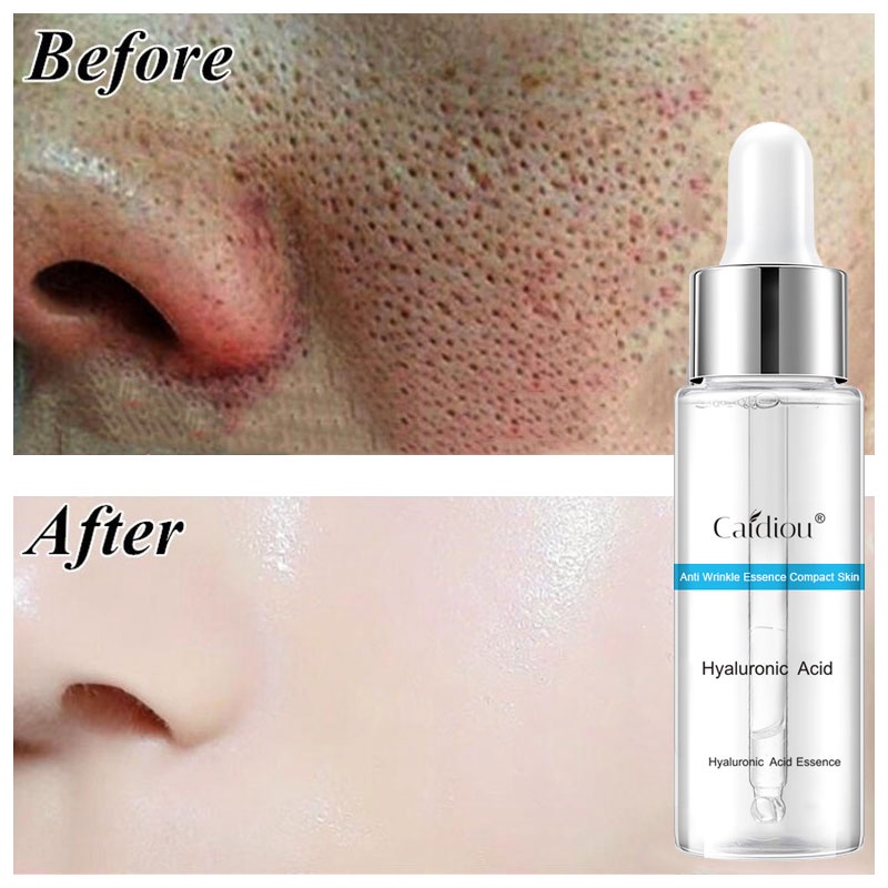 Tinh chất hyaluronic acid giúp dưỡng ẩm làm trắng se khít lỗ chân lông