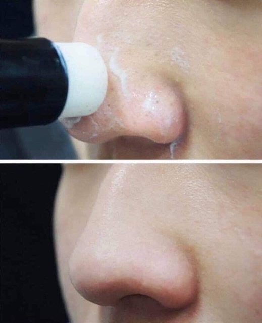 THANH TẨY MỤN ĐẦU ĐEN ALL KILL