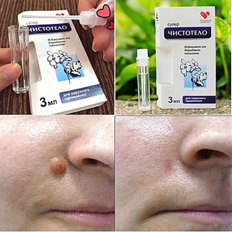 Gel tẩy nốt ruồi Nga