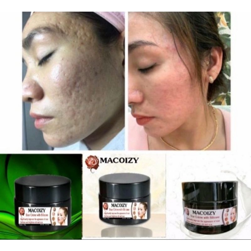 Kem Xóa Sẹo Rỗ MACOIZY Dưỡng Trắng Hết Thâm