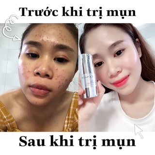 GEL CHẤM MỤN ANTI ACNE