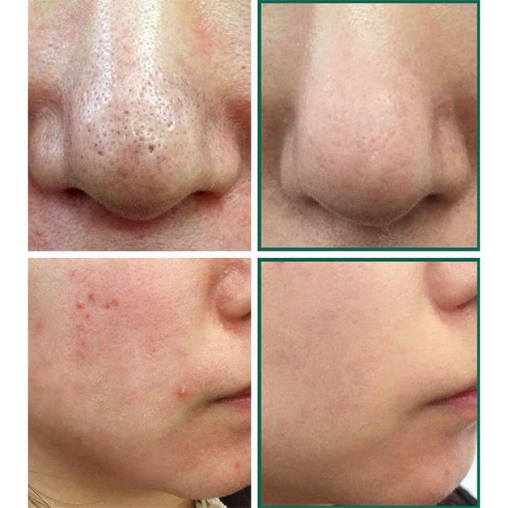 Kem dưỡng ngăn ngừa mụn và dưỡng trắng Kracie Hadabisei Acne