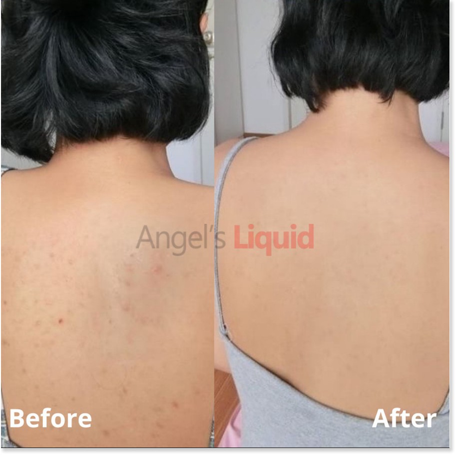 [Mã chiết khấu giảm giá mỹ phẩm chính hãng] Xịt Giảm Mụn Lưng Giảm Thâm Sau Mụn Angel's Liquid Glutathione+ Centella Cal