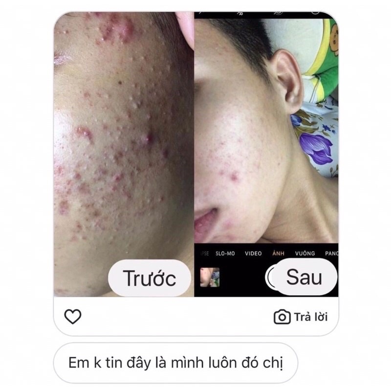 TURMERIC EXTRACT - KEM HỖ TRỢ ĐÁNH BAY CÁC LOẠI MỤN 20g