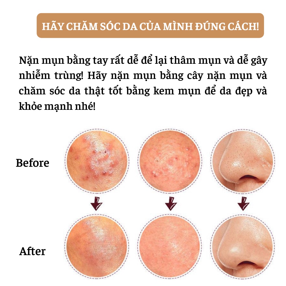 Cây que nặn mụn 2 đầu cao cấp Inox không gì BBC Cosmetic