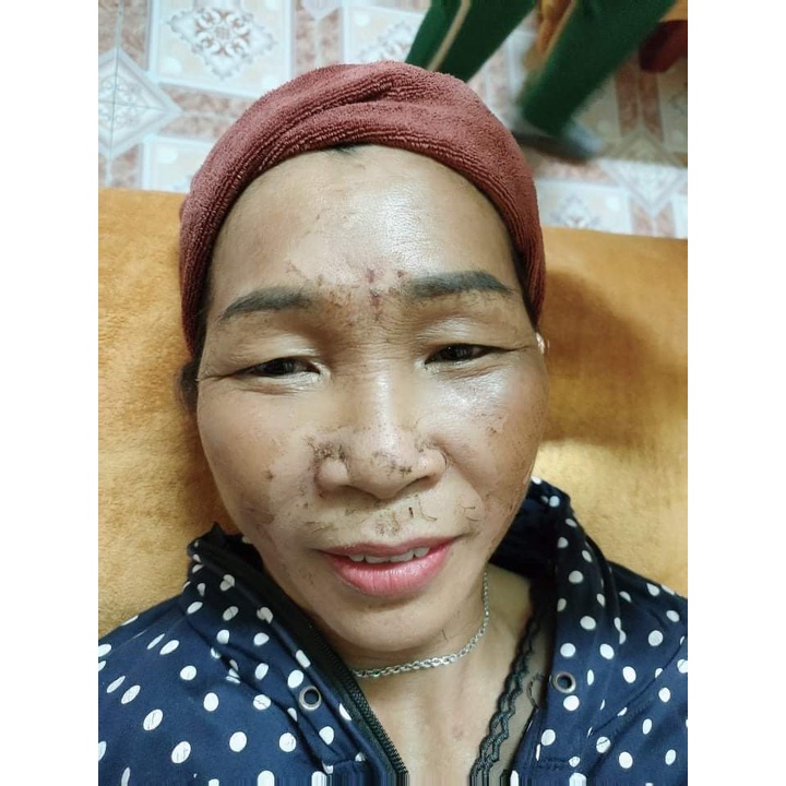Hút nám dịu nhẹ, lành tính giúp tái tạo da, sáng da, thải độc tố, giảm thâm, mờ nám spa