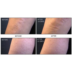 Tẩy da chết body First Aid Beauty KP Bump Eraser Body Scrub with 10% AHA.