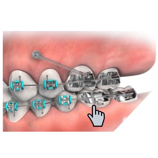 Khâu 2 ống chỉnh nha _DTC