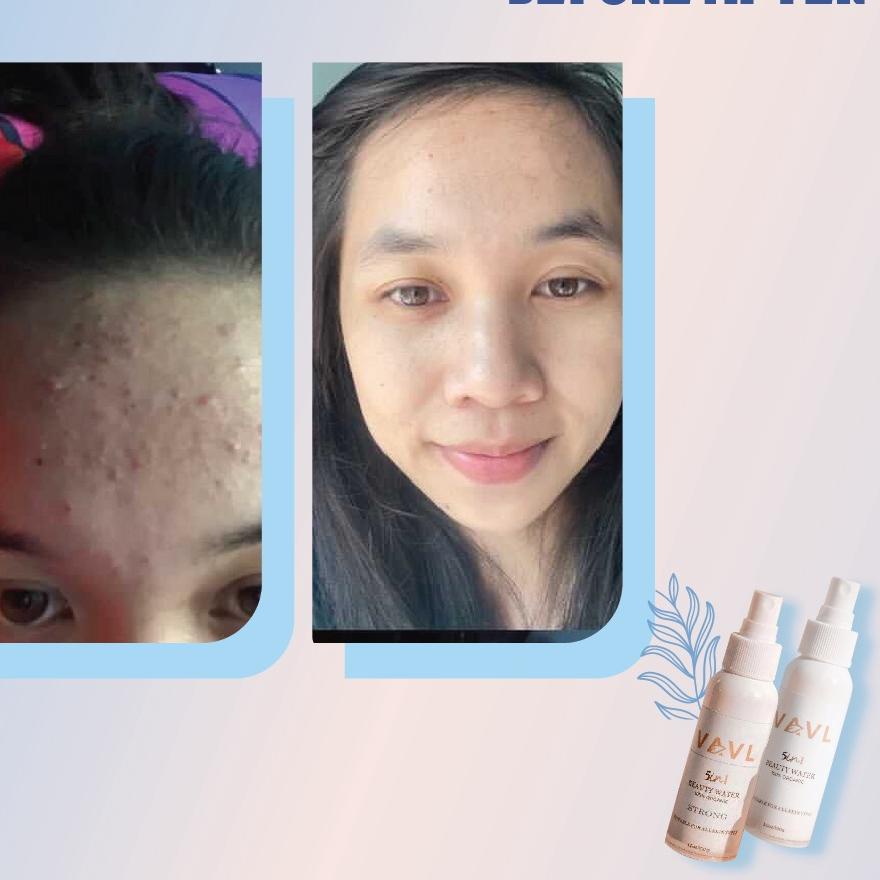 Hàng Có Sẵn - Túi Đựng Nước Trị Mụn Cơ Bản Và Thân Thiện Với Tình Trạng Thẩm Mỹ Viện (Vl